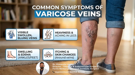 Top Warning Signs and Symptoms of Varicose Veins